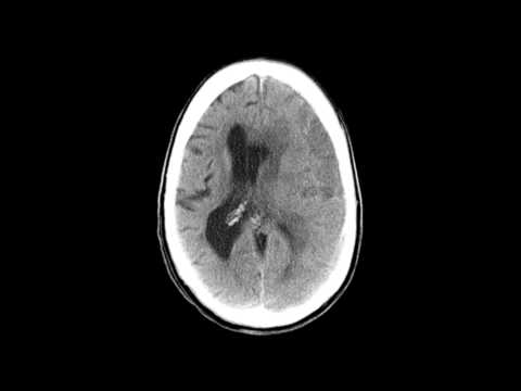 Subdural Hematoma - Before & After