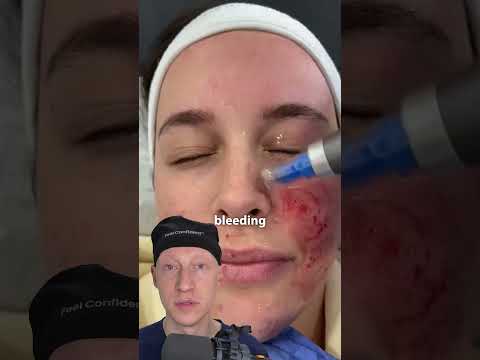 Would You Try Microneedling?