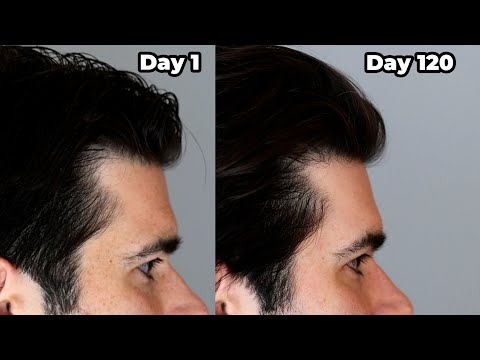 I put ROSEMARY OIL in My HAIR Everyday - 120 Day Results