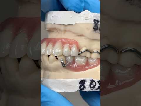 Maxillary and Mandibular Titanium Partials #lsk121shorts #dentist #teeth