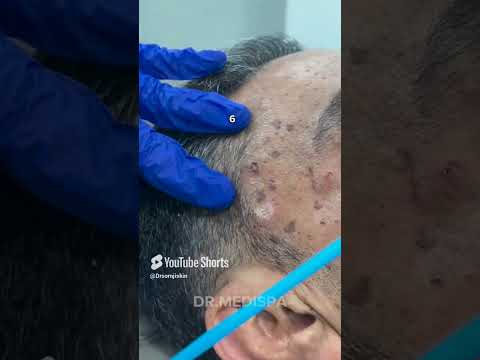 10 Moles Removed in Just 30 Seconds! - DrMedispa