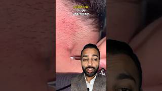 Ingrown Hair Extraction | Dr. Somji Reacts