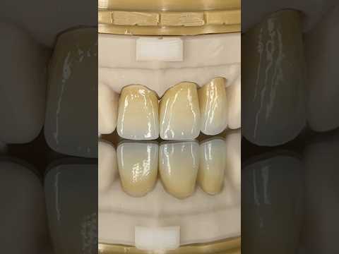 Anterior Zirconia Incisors #lsk121shorts #dentist #teeth