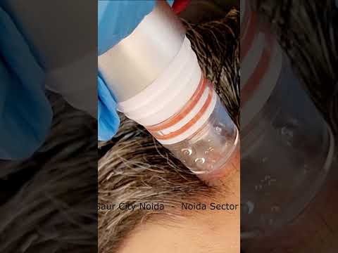 Dr. Rohit Goel | Scalp Hydra