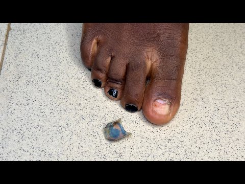 How I Removed My Big Toenail | DIY Big Toenail Removal atHome #toenails #nailremover #feet #feetnail