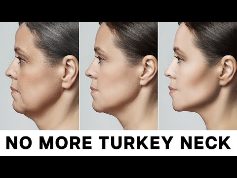 Get Rid of Turkey Neck! Dr. Somji Recommends These Top Treatments