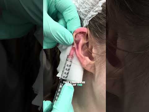 Shocking Ear Keloid Transformation | Before and After Revealed! #keloidtreatment #keloids