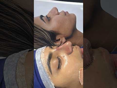 Best Before After Rhinoplasty - Cosmetic Nosejob