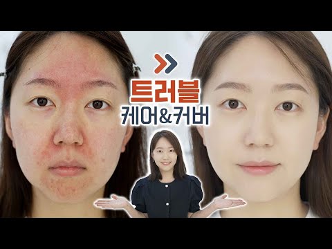 확 뒤집어진 피부, 금방 나을 수 있습니다. 가릴 수 있습니다. 트러블피부케어법, 피부 커버 방법