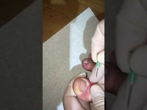 Squeeze the juice! Spurting puss from an infected toe