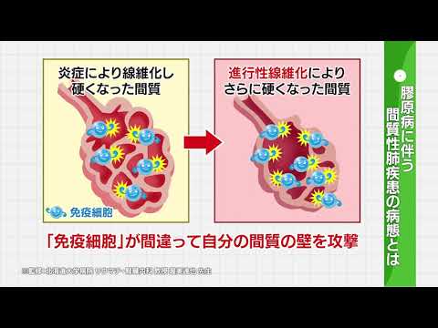 2022年9月10日放送　膠原病に伴う間質性肺疾患について