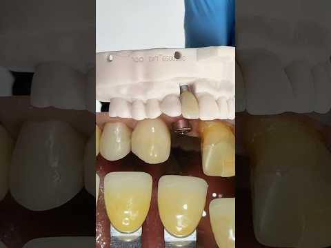 Lateral Implant #lsk121shorts #dentist #teeth