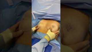 IMMEDIATELY AFTER SURGERY | BREAST LIFT