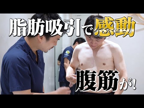 感動！脂肪吸引でさらなる高みへ【腹筋】