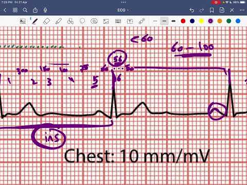 CASE_6 Sinus bradycardia