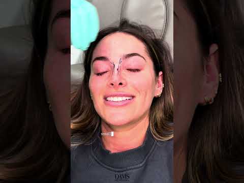 Non-Surgical Rhinoplasty for Courtney Green?  YES - DrMedispa