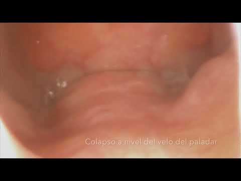 DISE Endoscopia del Sueño