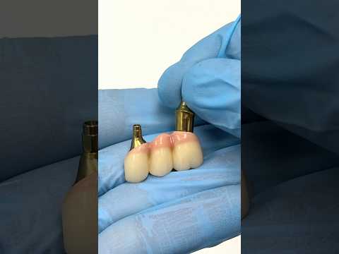 Ready to cement an exceptional Zirconia Implant #lsk121shorts #dentist #teeth