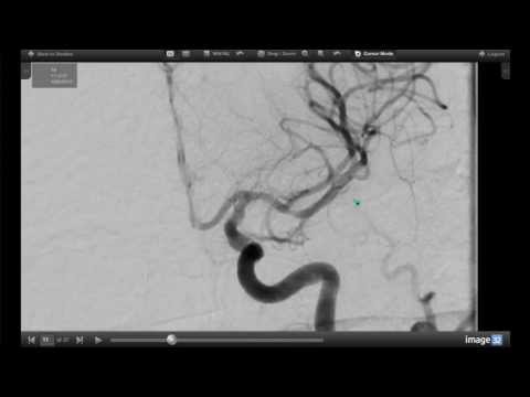 How Endovascular Stroke Treatment Works