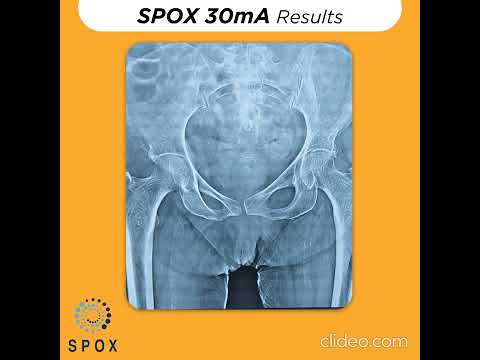 30mA Portable X-Ray....