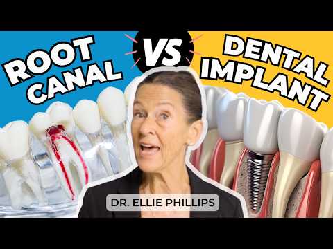 Root Canals vs Dental Implants: Which is Better for You?