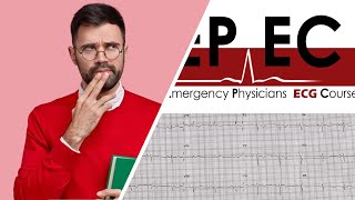 #EPEC​ ECG Cases (Case 28), How much do you know about ARVC?