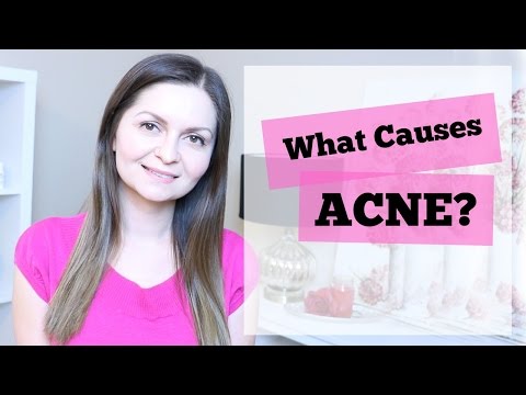 What Causes Acne & Pimples? | Acne Causes |  Is Acne Genetic?