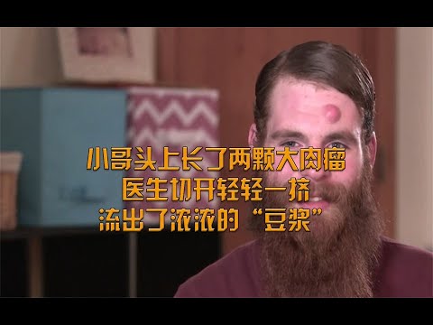 小哥头上长了两颗大肉瘤，医生轻轻一挤，流出了浓浓的“豆浆”