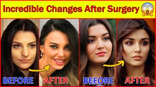 20 Turkish Actresses Before and After Surgery 😮, Plastic Surgery, Turkish Drama