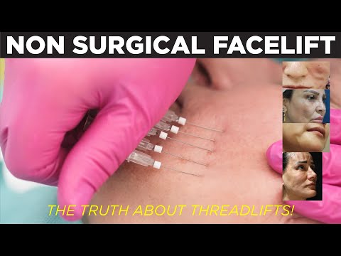 How To Have A Facelift WITHOUT Surgery? - All About Thread lifts By A Plastic Surgeon