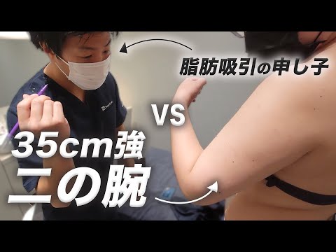 【凄すぎ】35cm二の腕を全周脂肪吸引で華奢腕にします|モッズクリニック 森祐揮