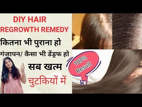 Hair fall (बाल झड़ना) कैसे रोके? बाल झड़ने गंजेपन का इलाज!Ganjapan ka ilaj ! Baal ugane ka tarika