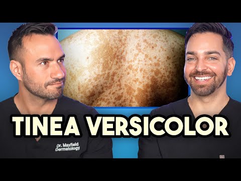 Patchy, Discolored Rash on the Body? How to Treat Tinea Versicolor like a Dermatologist