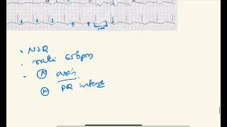 HYPOKALEMIA  ECG case #ecg #ecgcases #clinicalcases