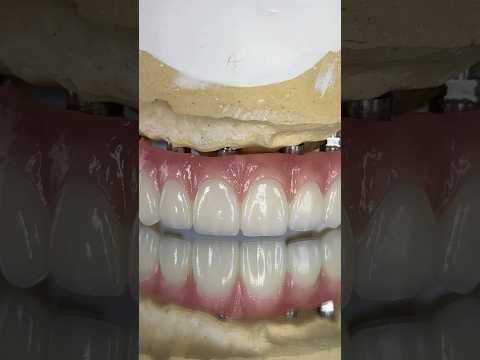 Full Mouth Zirconia Arch Implants #lsk121shorts #dentist #teeth