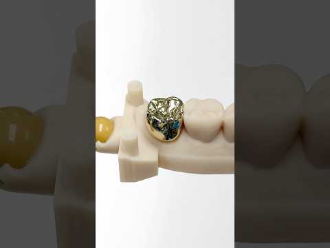 14Kt Gold Molar #lsk121shorts #dentist #teeth