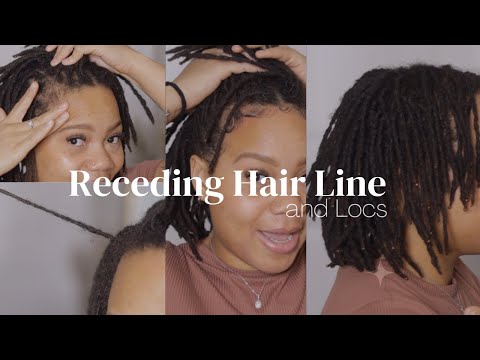 Receding Hair Line, Thinning Locs | The Truth About My Hairline