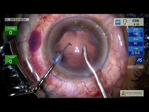 Surgical Performance of Quatera700 Versus Centurion and Signature Pro – Video S2 [456660]