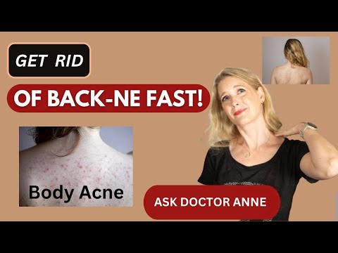 Unveiling the Ultimate Back Acne Treatment Tips with Doctor Anne