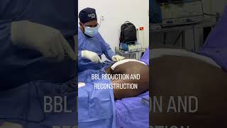 BBL REDUCTION & RECONSTRUCTION SURGERY (Brazilian Butt Lift) Hourglass Waist? by Dr Carlos Gómez