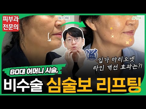 심술보, 심부볼, 마리오네트 주름 등 비수술로 없애는 방법📌 (50대,60대 리프팅 추천, 전후사진 등)