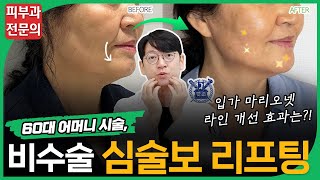 심술보, 심부볼, 마리오네트 주름 등 비수술로 없애는 방법📌 (50대,60대 리프팅 추천, 전후사진 등)