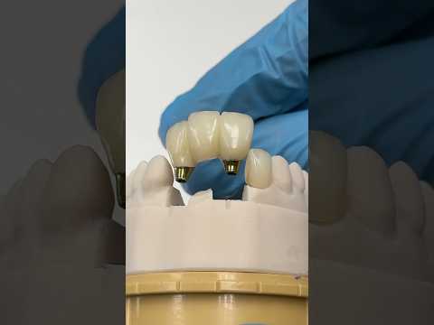 Zirconia Pontic Implant with a Lateral Crown #lsk121shorts #dentist #teeth