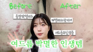 [Skincare] 광고❌❌ 여드름 4년간 쌩고생하며 찾은 피부광명템 추천 모음.zip │ 좁쌀여드름박멸템, 여드름싹잡은앰플,핵쉬운각질제거제추천, 여드름스팟케어추천