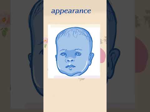 Noonan's syndrome || Dental syndrome