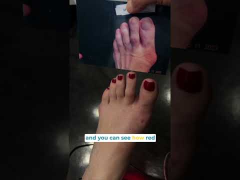 Another bunion bites the dust! #bunioncorrection #bunion