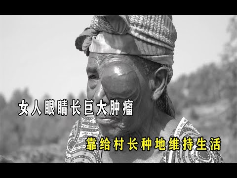 非洲女人右眼长出了肿瘤，被众人排挤独自生活，靠给村长种地维持