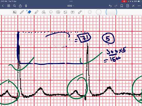 How to read ECG paper