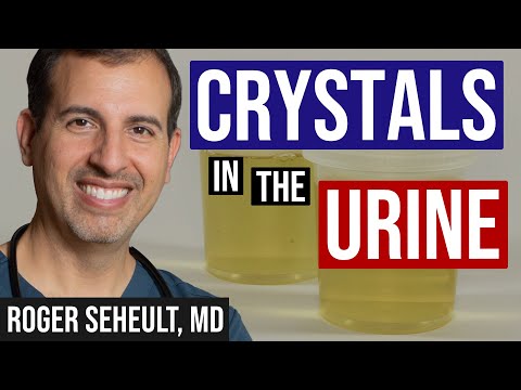 Review of Crystals Found in the Urine for Kidney Stones