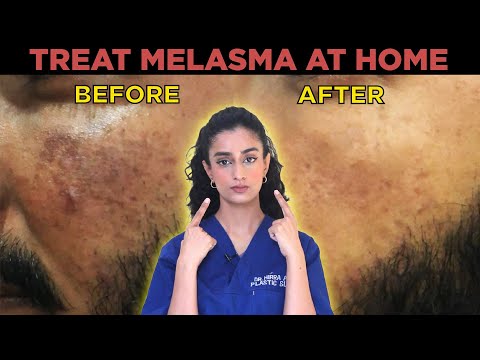 Treat melasma and dark spots at home- 2025 updated - Dr. Hirra Alavi